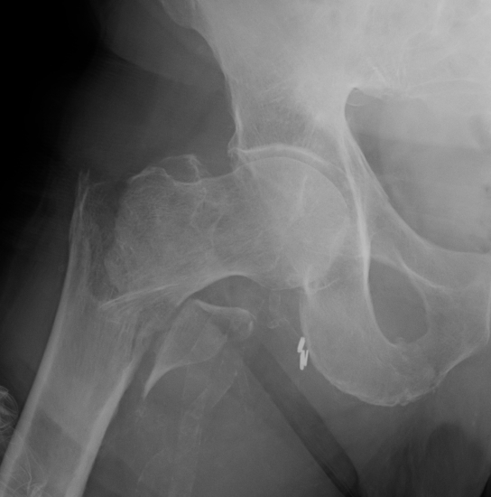 Hip Intertrochanteric fracture Type 4
